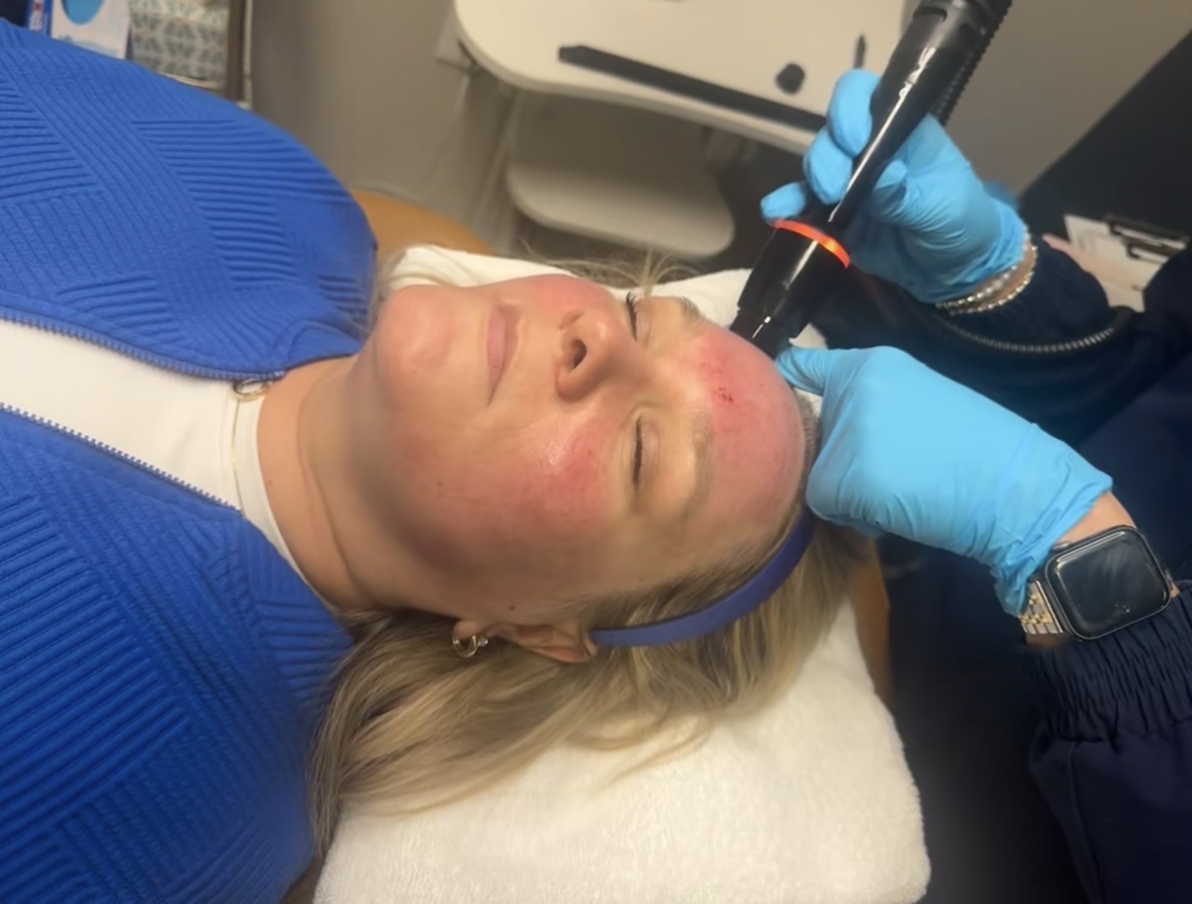 Microneedling